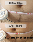 SculptAssure 1060nm Diode Laser Weight Loss Machine