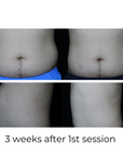 SculptAssure 1060nm Diode Laser Weight Loss Machine