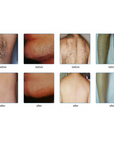 Before and after IPL hair removal treatment on Underarms, chin back, legs