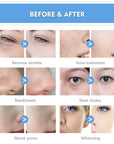 Before and After Use of Hydrafacial Machine, remove wrinkle, acne, blackhead, dark circles, shrink pores, whiten