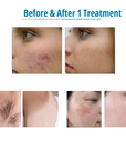 DermaLaze Delicate Pulsed Light System