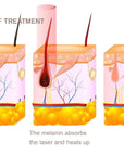 Principle of Diode Laser Skin Treatment for Hair Removal