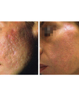 CoolPare EXPERT Fractional CO2 Laser