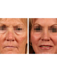 CoolPare EXPERT Fractional CO2 Laser