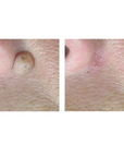 CoolPare EXPERT Fractional CO2 Laser