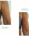 Reveal™ PRO SuperPulse CO2 Laser (Digital)