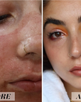 Reveal™ PRO SuperPulse CO2 Laser (Digital)