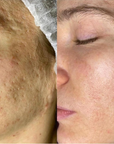 Reveal™ PRO SuperPulse CO2 Laser (Digital)