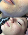Reveal™ PRO SuperPulse CO2 Laser (Digital)