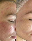 LumiSheer ComfortMax Diode Laser with RF (4 Wavelength)