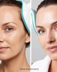 FrioLift Cryo + RF Contrast Skin Rejuvenation System