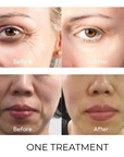 LuminaTight™ 10D HIFU Machine Professional