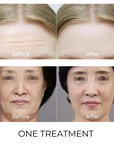 LuminaTight™ 10D HIFU Machine Professional