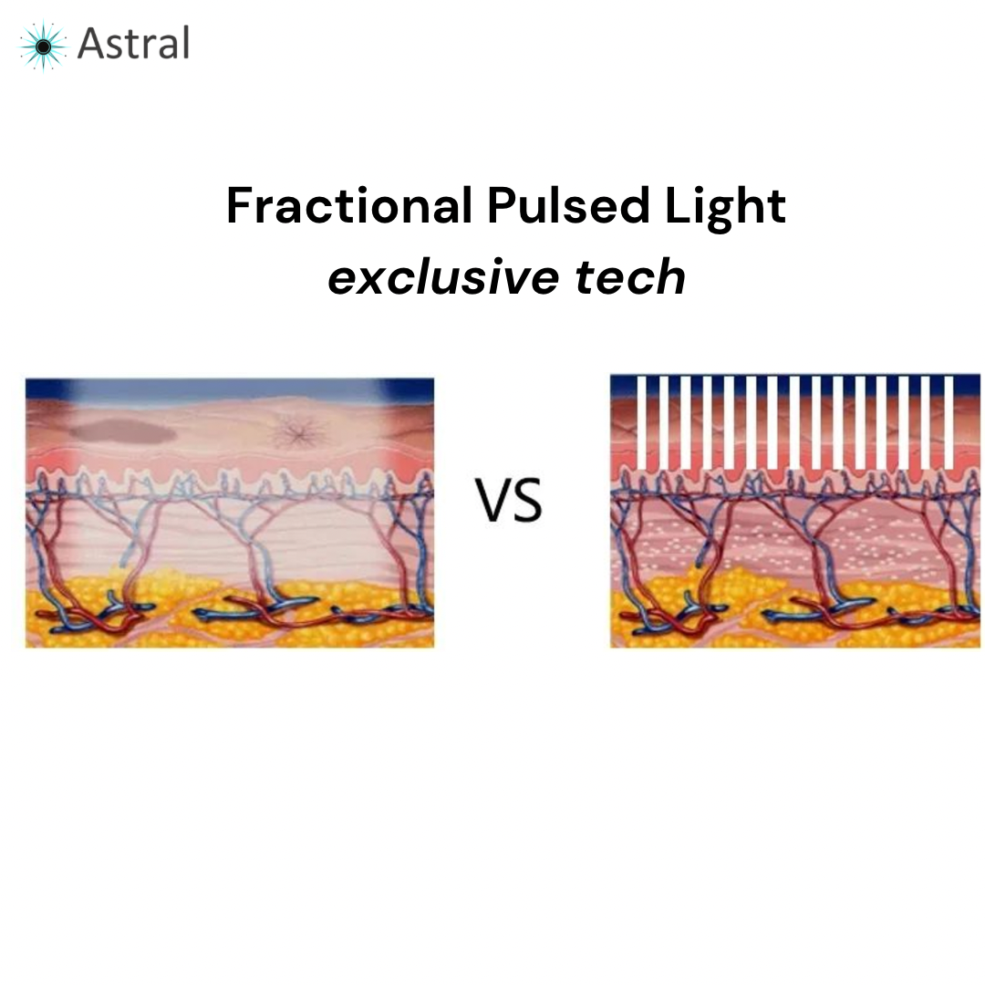 APEX™ 10D Professional Intense Pulsed Light System