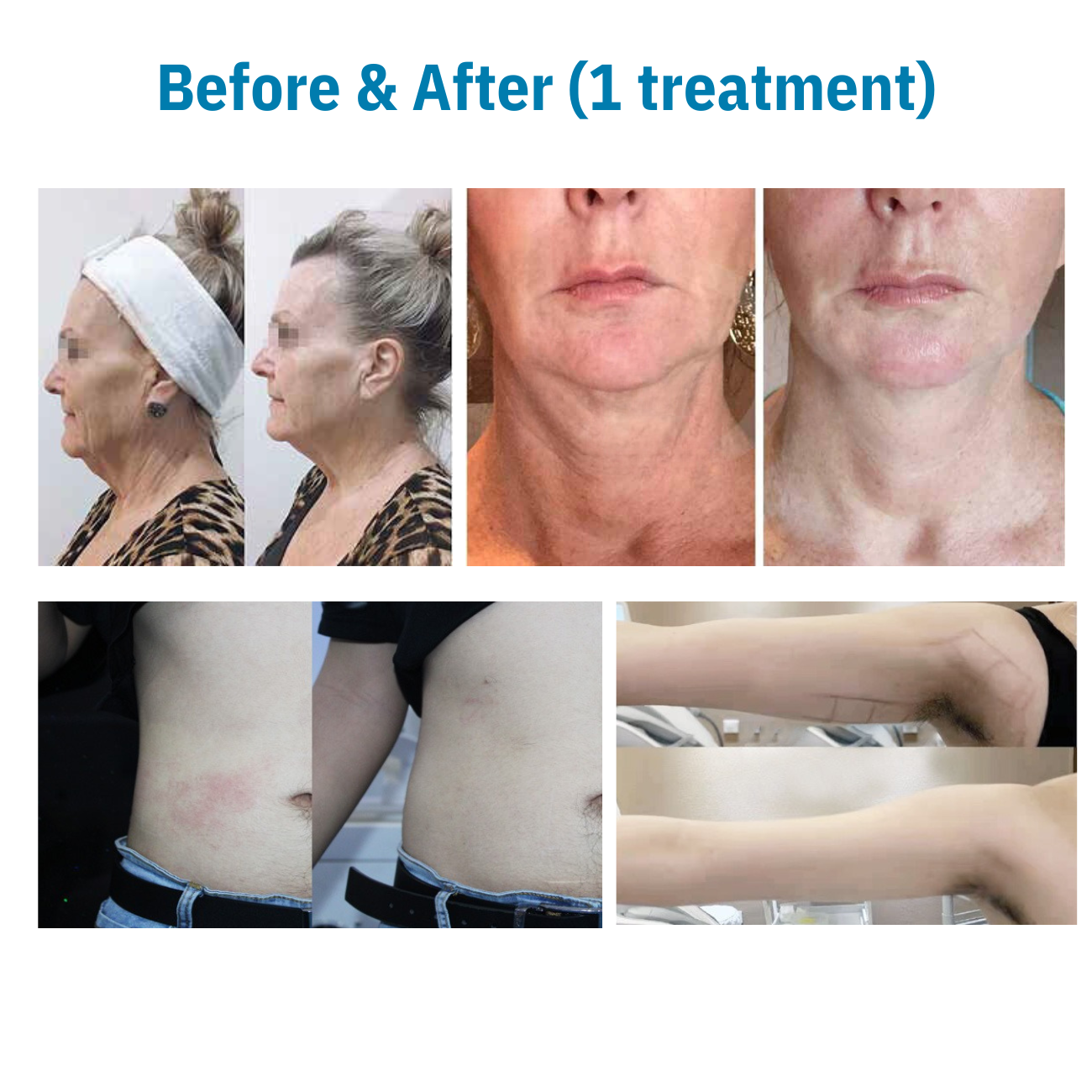 360 Ultra Formation Professional HIFU Machine for Body &amp; Face