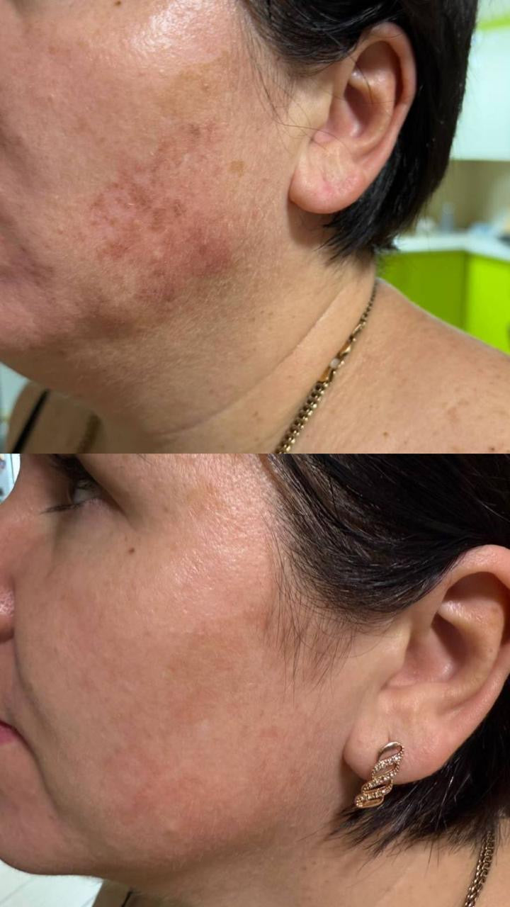 DuoSmooth 2-in-1 Diode Laser + IPL System