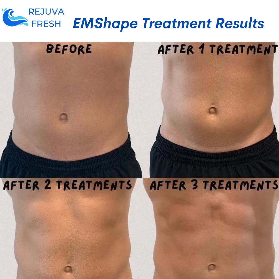 EMShape® Body Contouring Machine Professional | Best EMS Sculpting ...