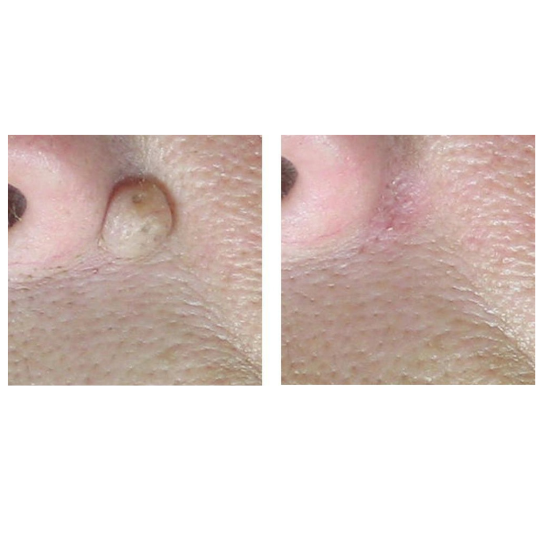 CoolPare EXPERT Fractional CO2 Laser