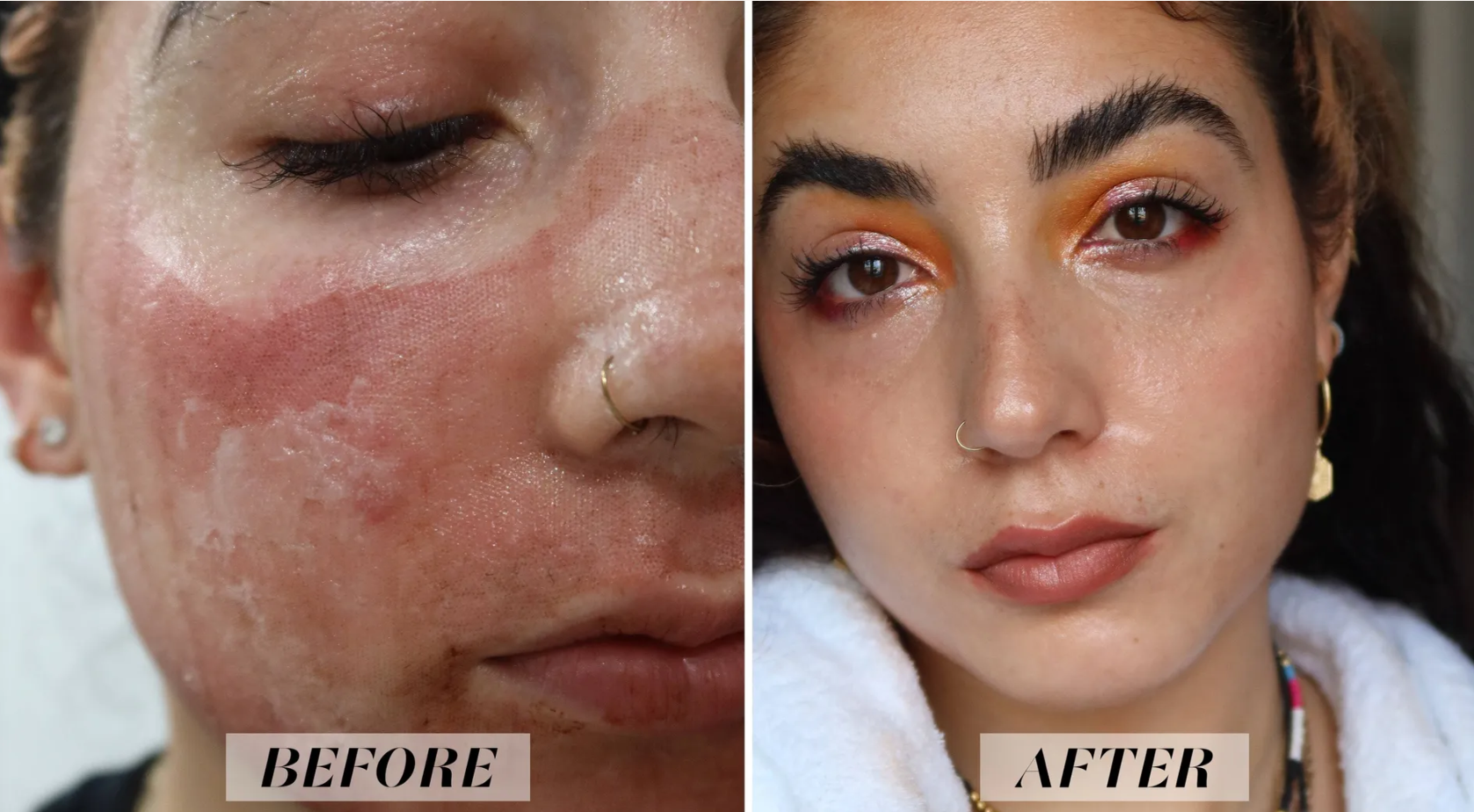Reveal™ PRO SuperPulse CO2 Laser (Digital)