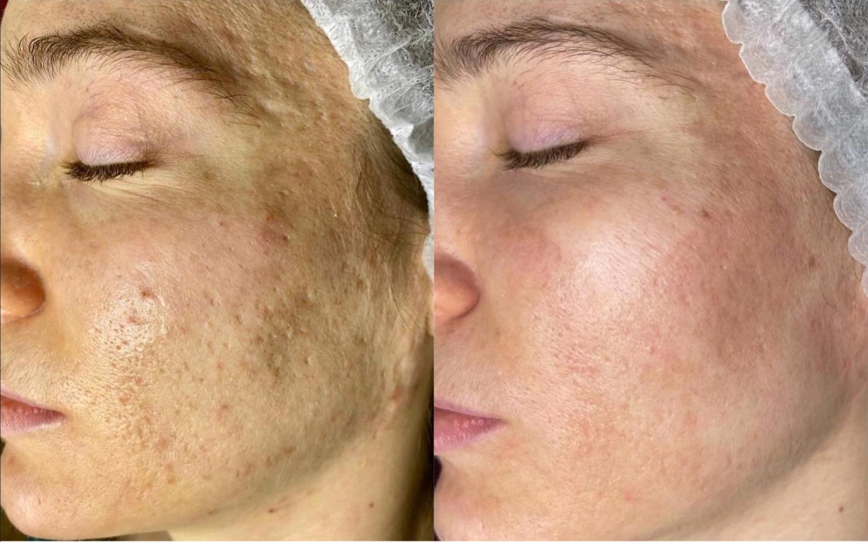 Reveal™ PRO SuperPulse CO2 Laser (Digital)