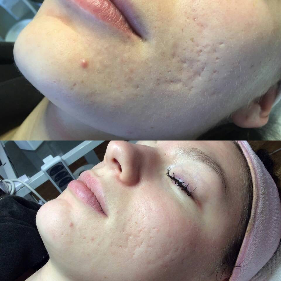 Reveal™ PRO SuperPulse CO2 Laser (Digital)