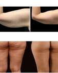 Adonis™ 30K Fat Blasting Cavitation Machine 6 in 1