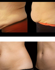 Before-and-after abdominal body contouring results shown from front and side views
